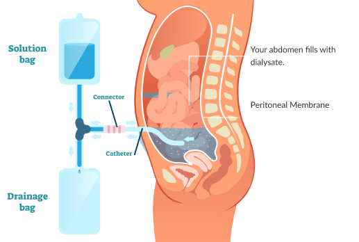 peritoneal dialysis illustration