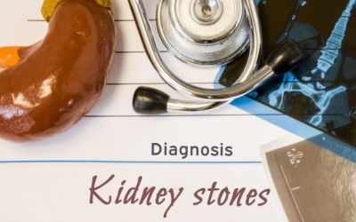 Kidney Stones (Urinary Stones) – Everything You Need to Know About Them